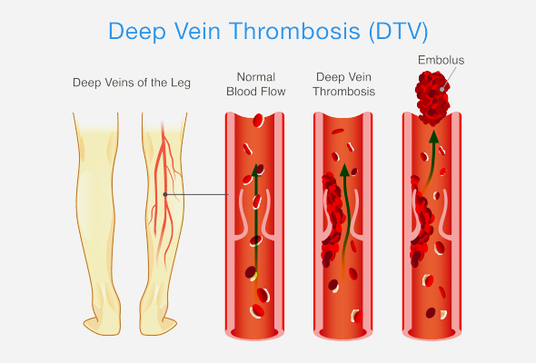 best deep vein thrombosis dvt treatment in mumbai