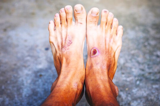 best diabetic foot ulcer treatment in andheri