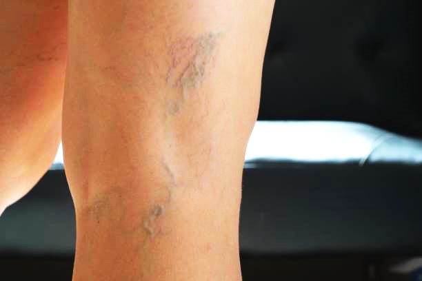 best varicose veins doctor in andheri