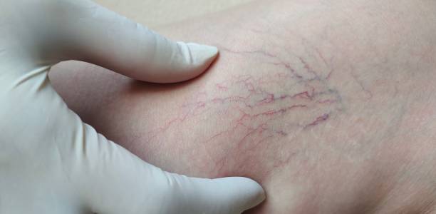 best varicose veins doctor in mumbai