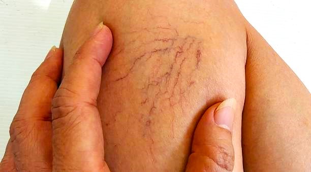 best variocose veins doctor in kandivali